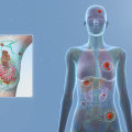Understanding Breast Cancer