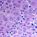 Understanding Mesothelioma