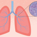 Understanding Lung Cancer - Causes, Symptoms, Treatment, and Support