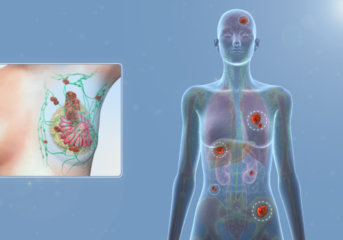 Understanding Breast Cancer