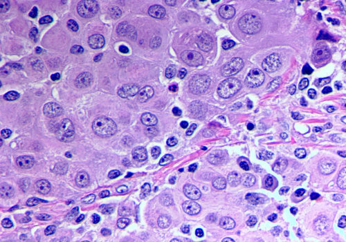 Understanding Mesothelioma