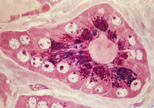 The Most Common Types of Cancer Worldwide